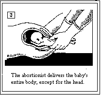 abortion facts